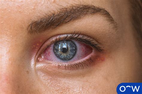 Ocular Herpes (Eye Herpes): Symptoms & Treatment 